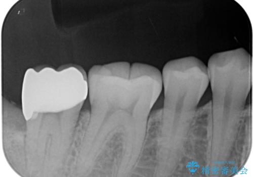 親知らずに影響で大きなむし歯に セラミッククラウンによるむし歯治療の治療後