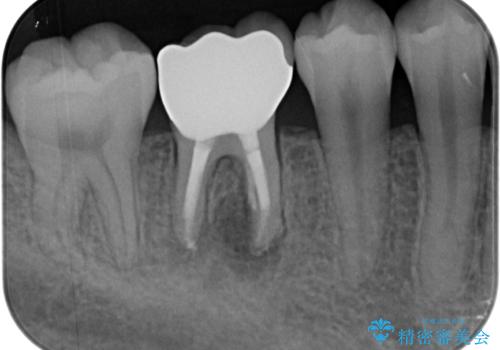 奥歯が痛い　オールセラミッククラウンでのむし歯治療の治療後