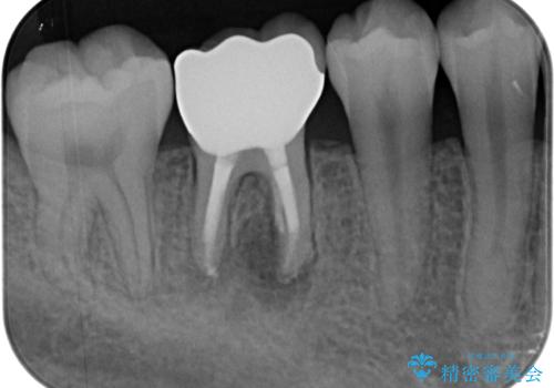 奥歯が痛い オールセラミッククラウンでのむし歯治療の治療後