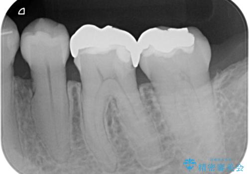銀歯の入った歯が欠けた　奥歯のオールセラミッククラウン補綴治療の治療前