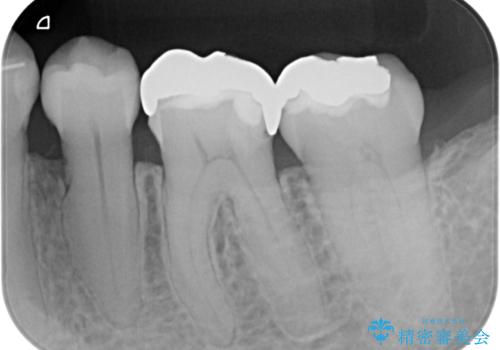 銀歯の入った歯が欠けた 奥歯のオールセラミッククラウン補綴治療の治療前