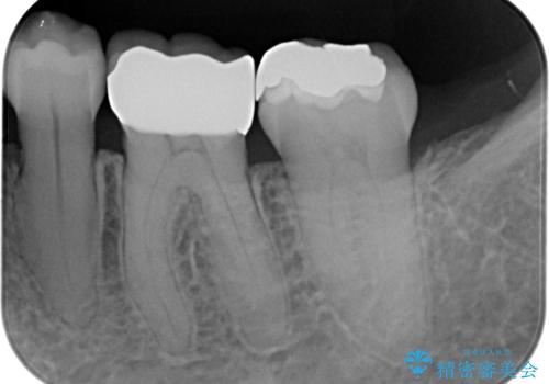 銀歯の入った歯が欠けた　奥歯のオールセラミッククラウン補綴治療の治療後