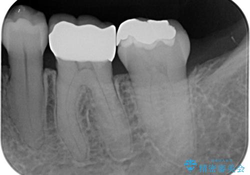 銀歯の入った歯が欠けた 奥歯のオールセラミッククラウン補綴治療の治療後