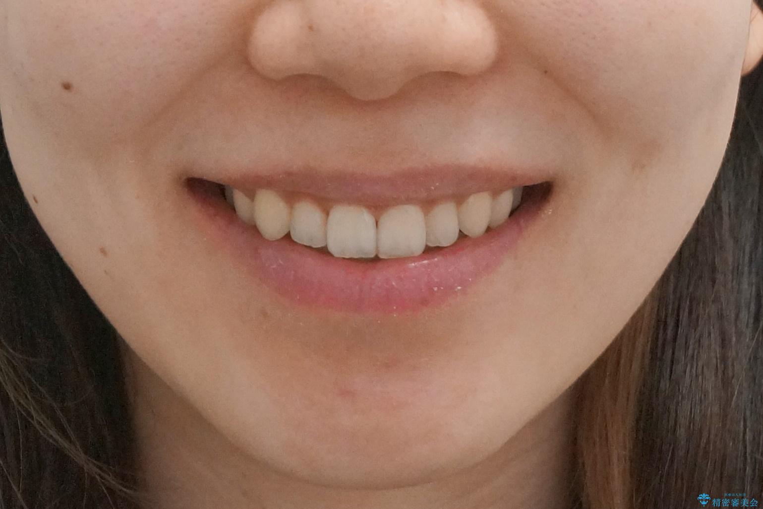 八重歯 歯を抜かずにマウスピース矯正で インプラント矯正で上の奥歯を後ろに移動の治療後(顔貌)