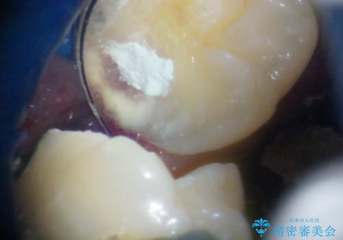 親知らずに影響で大きなむし歯に セラミッククラウンによるむし歯治療の治療中