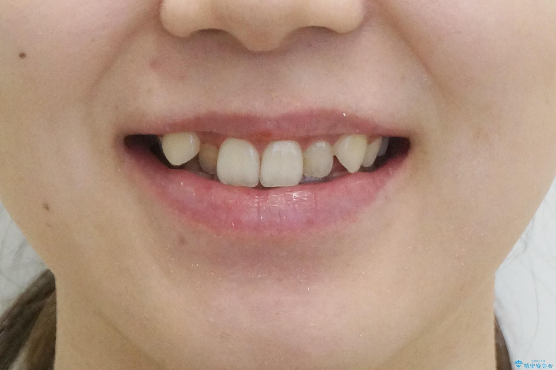 八重歯 歯を抜かずにマウスピース矯正で インプラント矯正で上の奥歯を後ろに移動の治療前(顔貌)