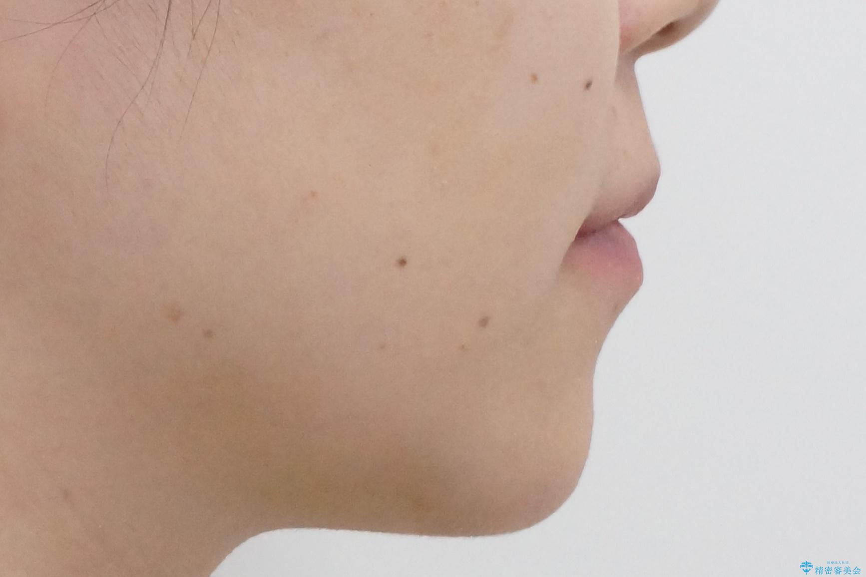 八重歯 歯を抜かずにマウスピース矯正で インプラント矯正で上の奥歯を後ろに移動の治療前(顔貌)