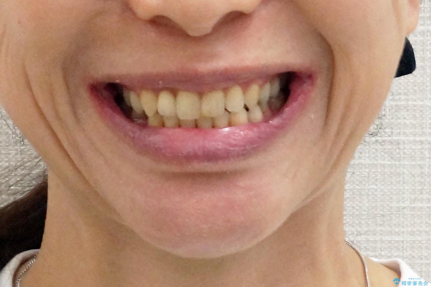 矮小(わいしょう)歯の形をセラミックで自然に 50代女性の治療後(顔貌)
