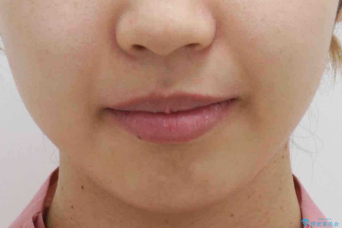 重度のがたつき 矯正治療+セラミック治療で綺麗な歯並びに 矯正専門では難しい治療の治療後(顔貌)