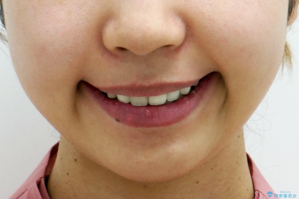 重度のがたつき 矯正治療+セラミック治療で綺麗な歯並びに 矯正専門では難しい治療の治療後(顔貌)