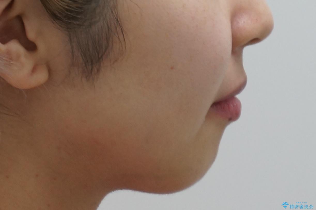 重度のがたつき 矯正治療+セラミック治療で綺麗な歯並びに 矯正専門では難しい治療の治療後(顔貌)