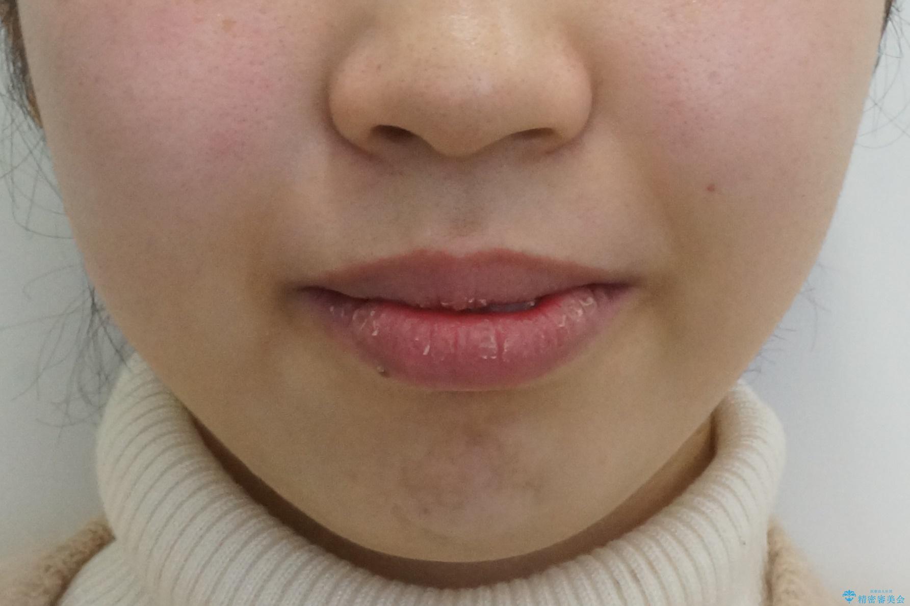 重度のがたつき 矯正治療+セラミック治療で綺麗な歯並びに 矯正専門では難しい治療の治療前(顔貌)