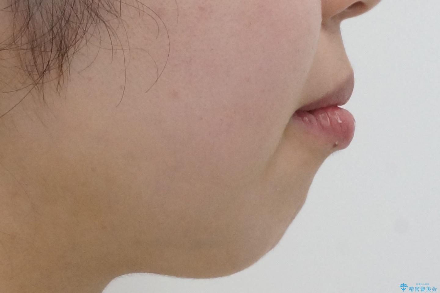 重度のがたつき 矯正治療+セラミック治療で綺麗な歯並びに 矯正専門では難しい治療の治療前(顔貌)