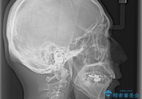 八重歯と突出感を改善 ワイヤー装置での矯正治療の治療前