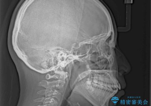 飛び出した上顎前歯 抜歯矯正で横顔の印象を改善の治療前