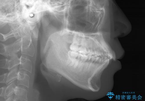 裏側装置で目立たず矯正!の治療前