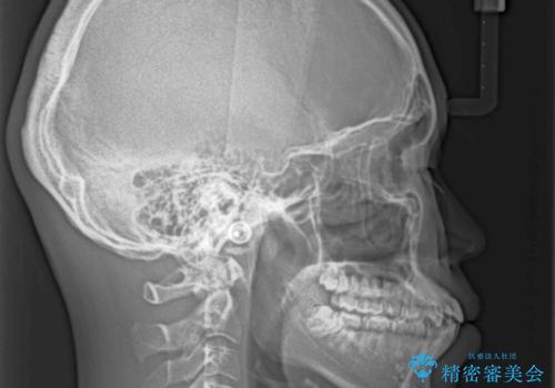 突出した口元 ワイヤー装置で横顔の印象を改善の治療前