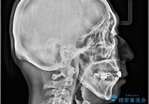 八重歯と突出感を改善 ワイヤー装置での矯正治療の治療後