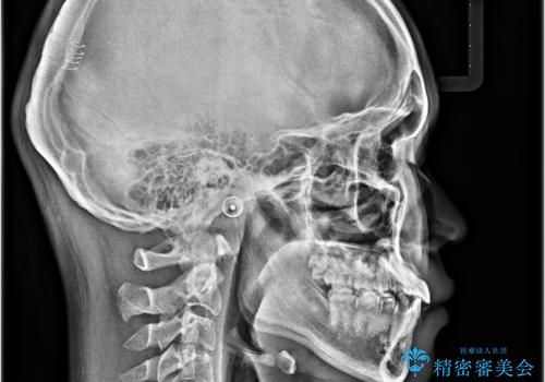 突出した口元 ワイヤー装置で横顔の印象を改善の治療後