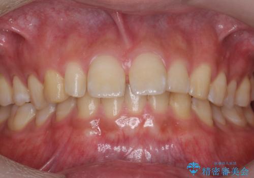 前歯のすき間　小さい歯がある　前歯の並びをきれいにしたいの治療前