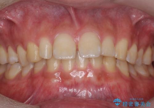 前歯のすき間 小さい歯がある 前歯の並びをきれいにしたいの症例 治療前