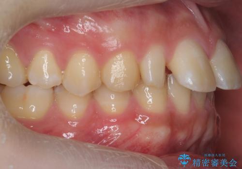 前歯のすき間 小さい歯がある 前歯の並びをきれいにしたいの治療前