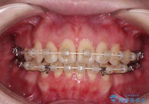 飛び出した上顎前歯 抜歯矯正で横顔の印象を改善の治療中