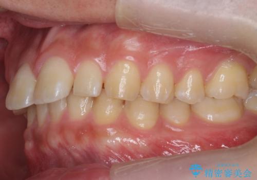 前歯のすき間 小さい歯がある 前歯の並びをきれいにしたいの治療前