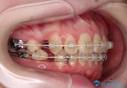 飛び出した上顎前歯　抜歯矯正で横顔の印象を改善の治療中