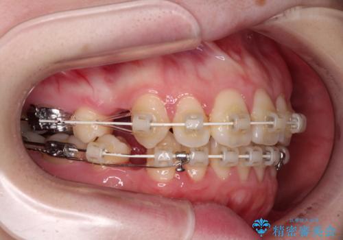 飛び出した上顎前歯 抜歯矯正で横顔の印象を改善の治療中