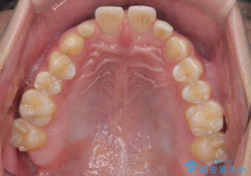 前歯のすき間 小さい歯がある 前歯の並びをきれいにしたいの治療前