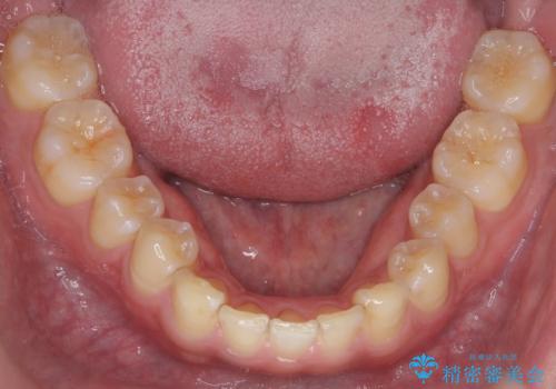 前歯のすき間 小さい歯がある 前歯の並びをきれいにしたいの治療前