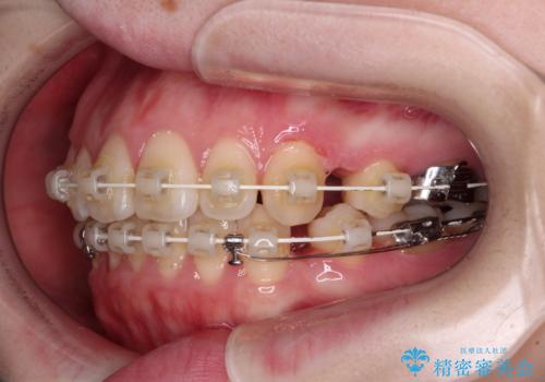 飛び出した上顎前歯 抜歯矯正で横顔の印象を改善の治療中
