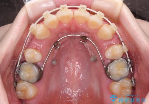 飛び出した上顎前歯　抜歯矯正で横顔の印象を改善の治療中