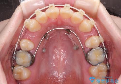 飛び出した上顎前歯 抜歯矯正で横顔の印象を改善の治療中