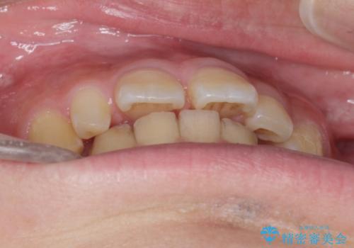 前歯のすき間 小さい歯がある 前歯の並びをきれいにしたい