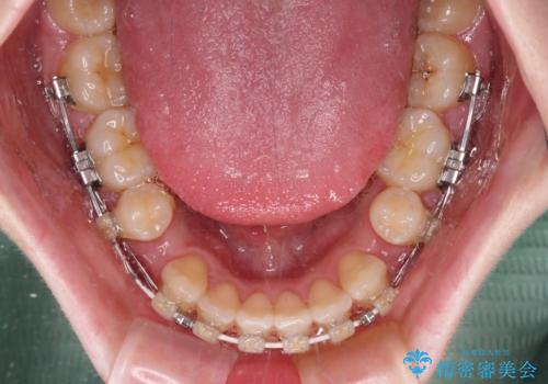 飛び出した上顎前歯 抜歯矯正で横顔の印象を改善の治療中