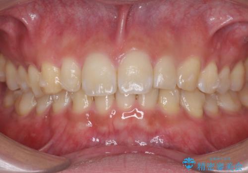 前歯のすき間 小さい歯がある 前歯の並びをきれいにしたいの治療中