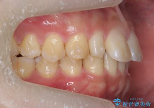 前歯のすき間 小さい歯がある 前歯の並びをきれいにしたいの治療中