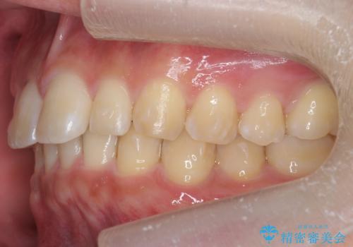 前歯のすき間 小さい歯がある 前歯の並びをきれいにしたいの治療中