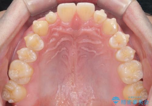 前歯のすき間 小さい歯がある 前歯の並びをきれいにしたいの治療中