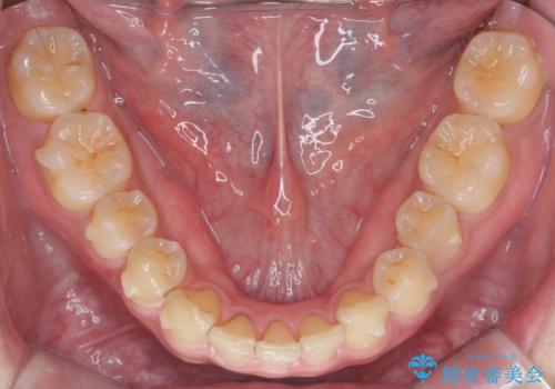 前歯のすき間 小さい歯がある 前歯の並びをきれいにしたいの治療中