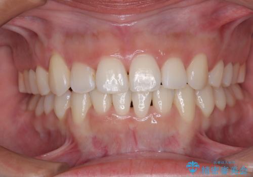 急速拡大装置 狭い歯列を拡大して短期間での矯正治療