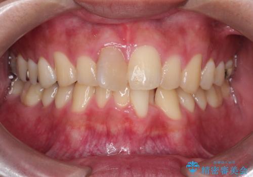 【インビザライン 非抜歯】歯の捻じれと歯のでこぼこを治したい!の治療前