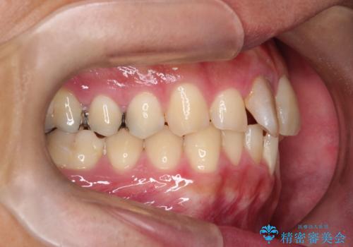 【インビザライン 非抜歯】歯の捻じれと歯のでこぼこを治したい!の治療前