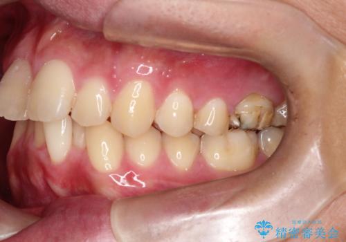 【インビザライン 非抜歯】歯の捻じれと歯のでこぼこを治したい!の治療前