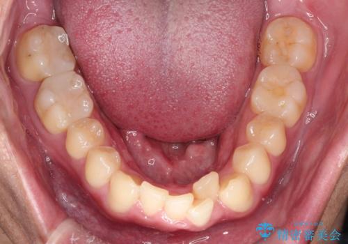 【インビザライン 非抜歯】歯の捻じれと歯のでこぼこを治したい!の治療前