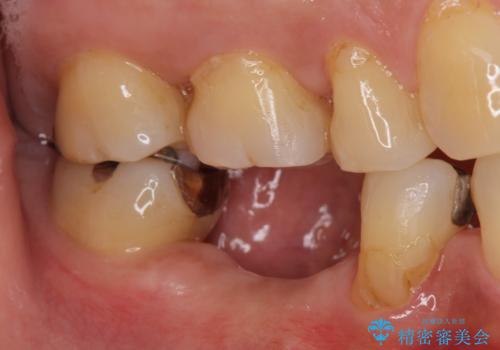 歯槽堤保存術 → インプラント治療の治療前