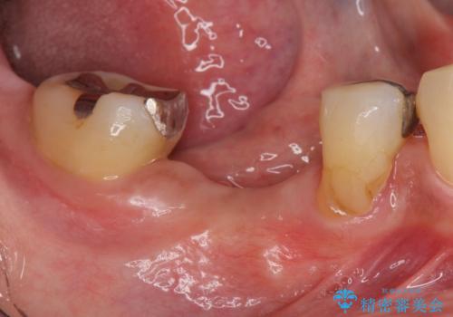 歯槽堤保存術 → インプラント治療の治療前