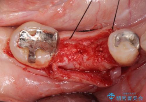 歯槽堤保存術 → インプラント治療の治療前